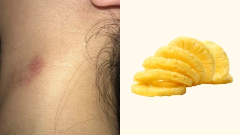 Bạn có thể đặt một lát dứa lên vết hickey để giảm đau, làm mờ vết bầm