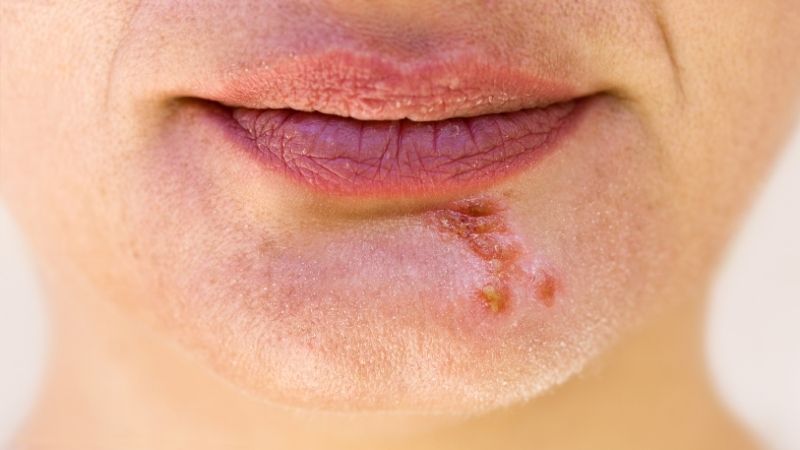 Bạn có thể nhiễm virus herpes qua vết hickey