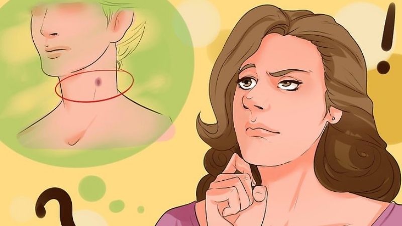 Vết hickey có thể tồn tại từ 3 ngày đến 2 tuần, tùy cơ địa mỗi người