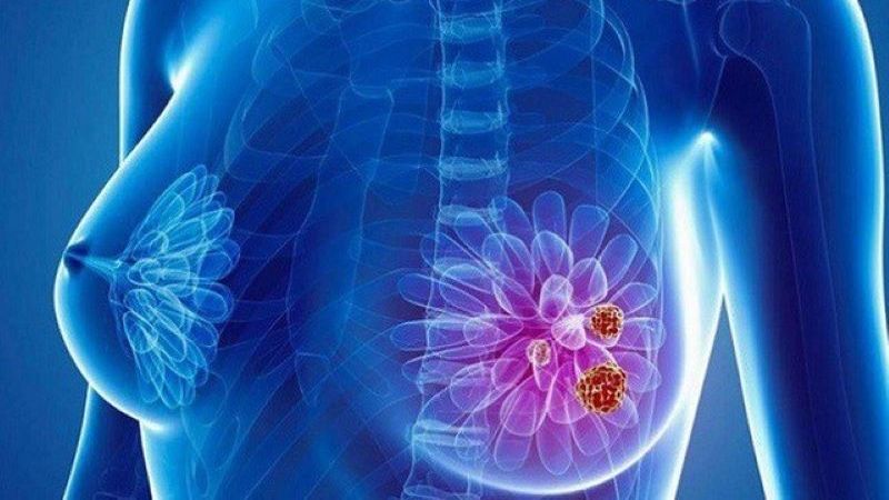 Giai đoạn đầu ung thư vú ở nữ giới thường chưa có triệu chứng rõ ràng