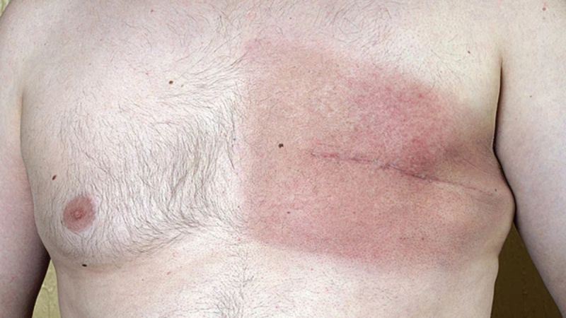 Ung thư vú ở nam giới thường khó phát hiện trong giai đoạn đầu của bệnh
