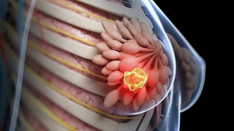 Ung thư vú nếu được chẩn đoán sớm thì thường có tiên lượng điều trị tốt