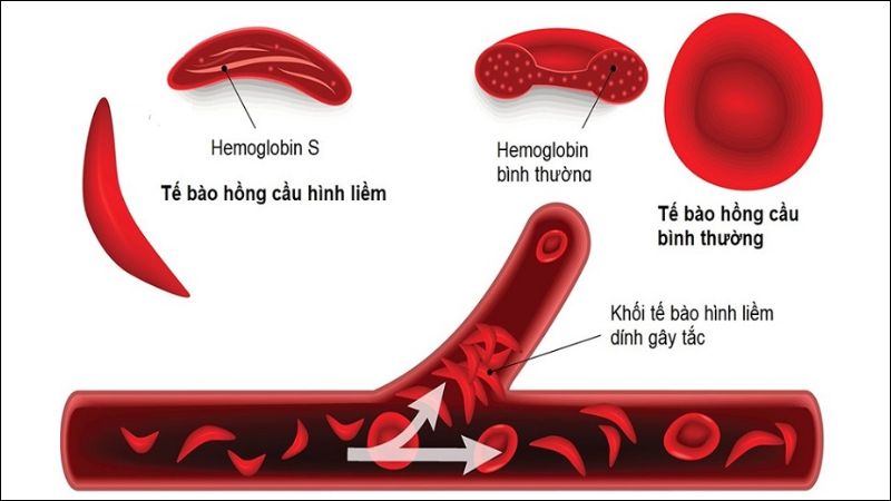 Cam thảo đất có thể hỗ trợ điều trị các rối loạn hồng cầu hình liềm