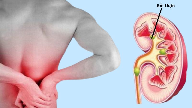 Cam thảo đất có tác dụng hỗ trợ phòng ngừa sỏi thận