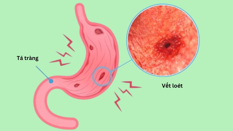 Cam thảo đất có thể được sử dụng trong hỗ trợ điều trị viêm loét dạ dày