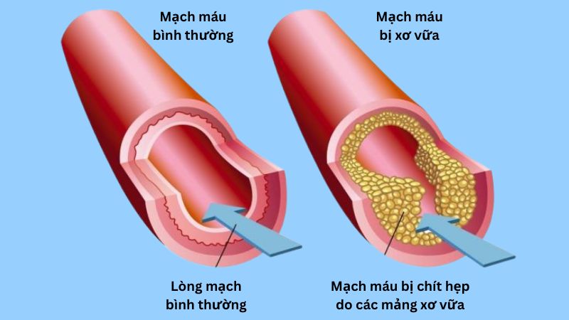 Cam thảo đất có tiềm năng bảo vệ tim mạch và phòng ngừa các bệnh liên quan đến xơ vữa động mạch