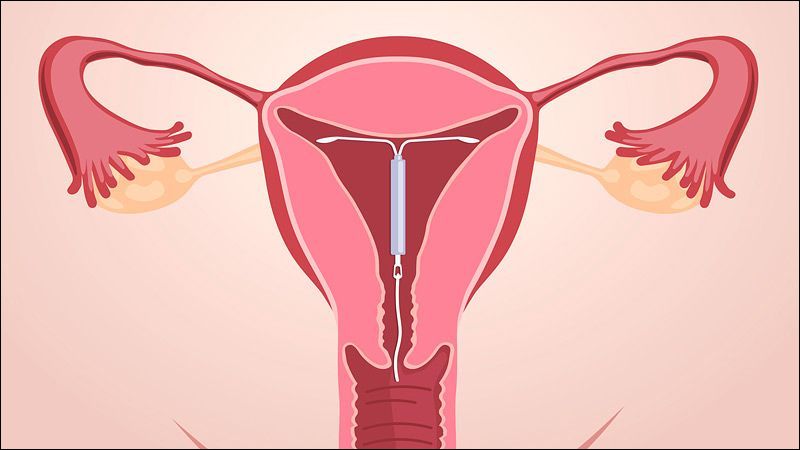 Thủng tử cung là biến chứng nghiêm trọng có thể xảy ra khi đặt vòng tránh thai Thủng tử cung là biến chứng nghiêm trọng có thể xảy ra khi đặt vòng tránh thai