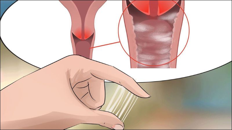 Sự thay đổi về dịch tiết âm đạo có thể là dấu hiệu của nhiễm trùng vùng chậu Sự thay đổi về dịch tiết âm đạo có thể là dấu hiệu của nhiễm trùng vùng chậu