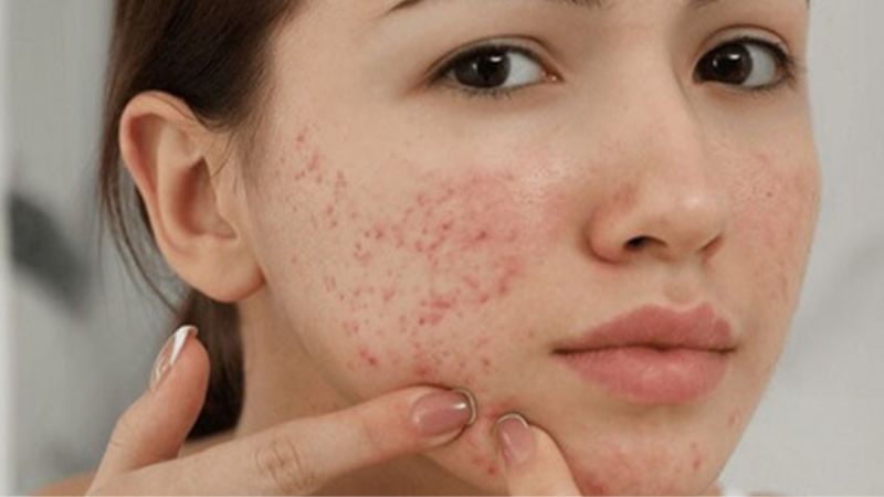 Vòng tránh thai chứa hormone có thể gây ra mụn trứng cá Vòng tránh thai chứa hormone có thể gây ra mụn trứng cá