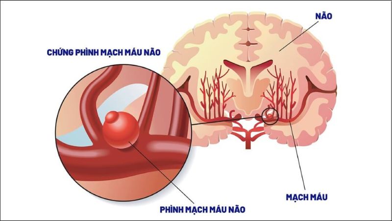 Cười quá lớn trong thời gian dài tạo áp lực đột ngột lên thành mạch, tăng nguy cơ phình mạch máu não
