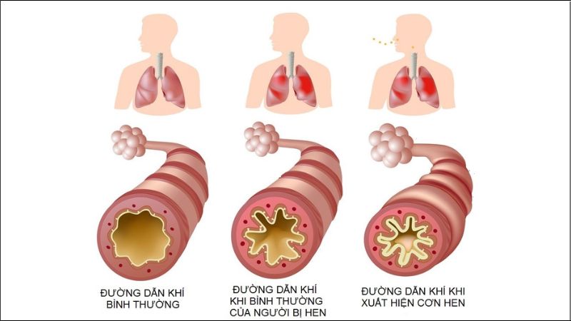 Những yếu tố cảm xúc như căng thẳng, khóc hoặc cười làm khởi phát triệu chứng hen