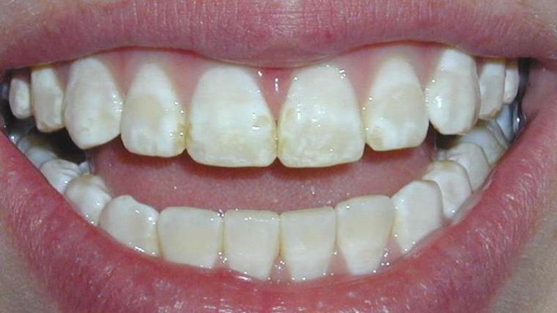 Baking soda có thể gây phá hủy men răng khi dùng không đúng cách Baking soda có thể gây phá hủy men răng khi dùng không đúng cách