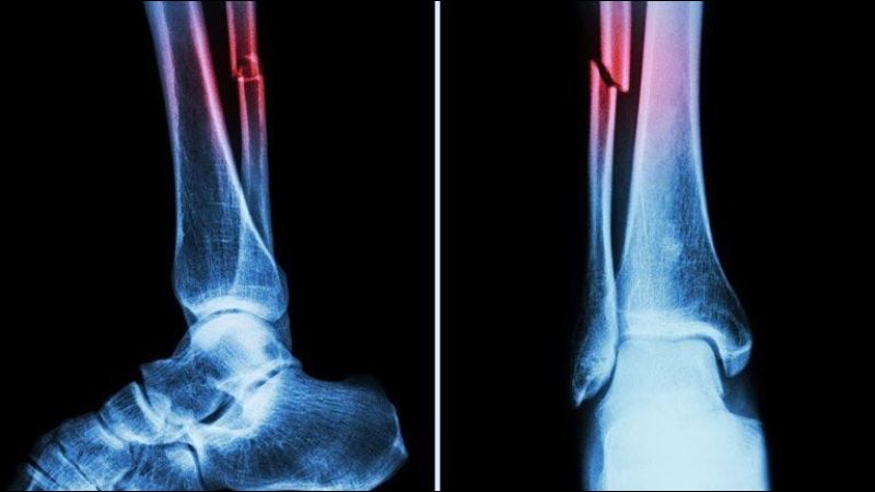 Bài thuốc giữa hợp hoan bì và giới thái tử giúp trị gãy xương do chấn thương