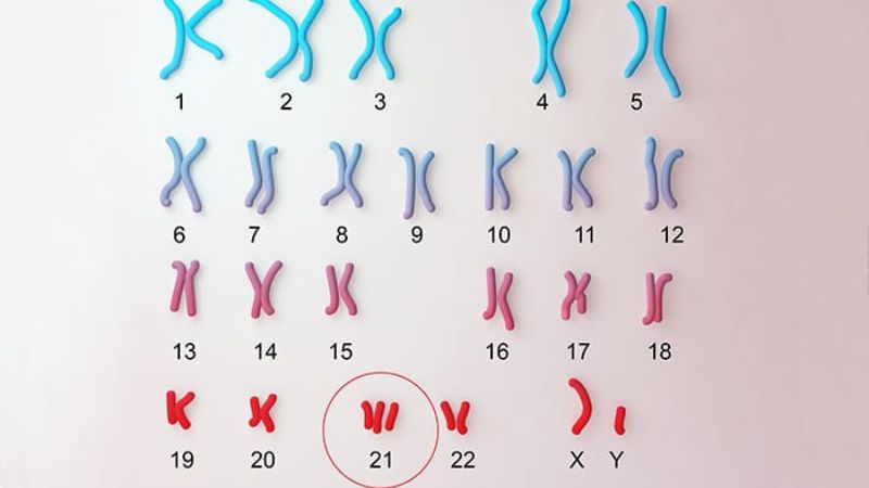 Xét nghiệm NIPT giúp phát hiện hội chứng Down do bất thường ở nhiễm sắc thể số 21