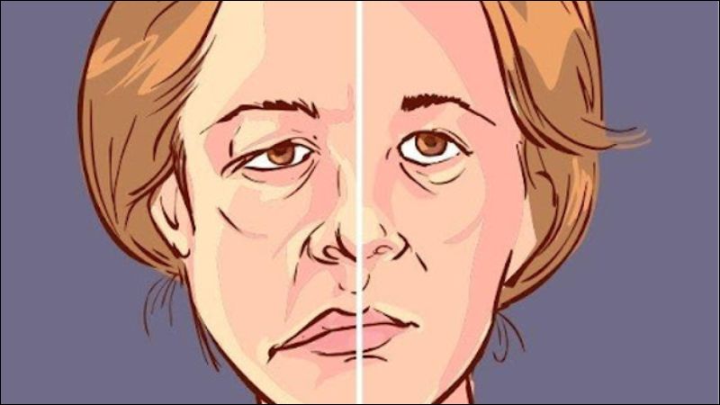 Méo miệng là đi chưng thường gặp sau tai biến mạch máu não