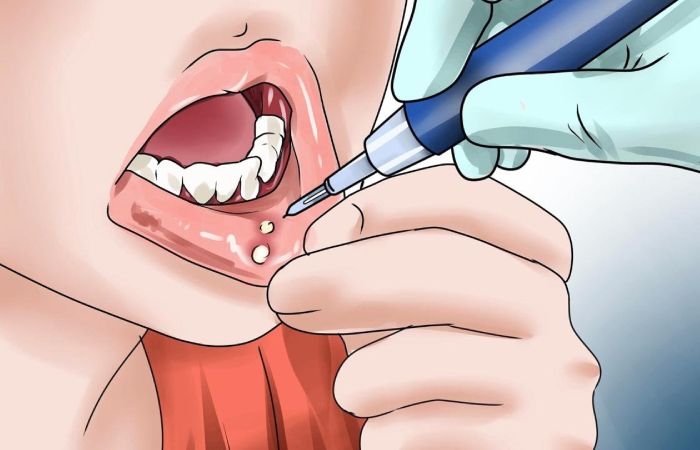 nhiệt miệng là một dạng vết thương hở, một vết loét miệng trên lớp niêm mạc mỏng manh