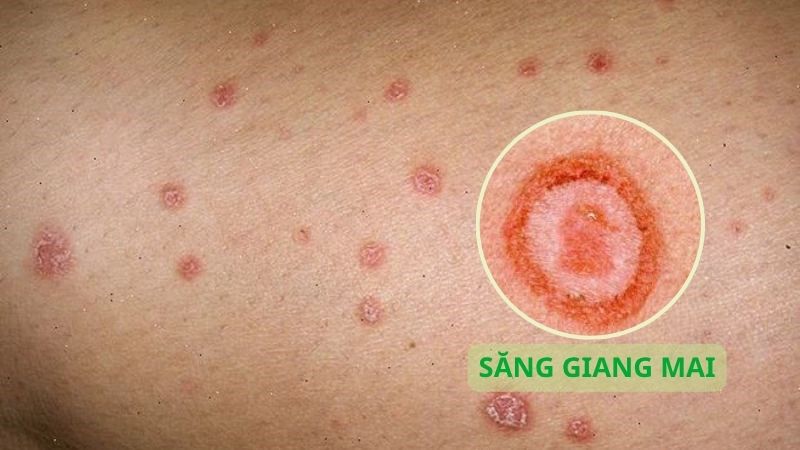 Săng giang mai là vết loét nông, tròn, có kích thước khoản 0,3 đến 3 cm Săng giang mai là vết loét nông, tròn, có kích thước khoản 0,3 đến 3 cm