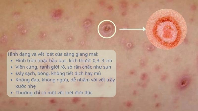 Hình dạng và vết loét sang giang mai Hình dạng và vết loét sang giang mai