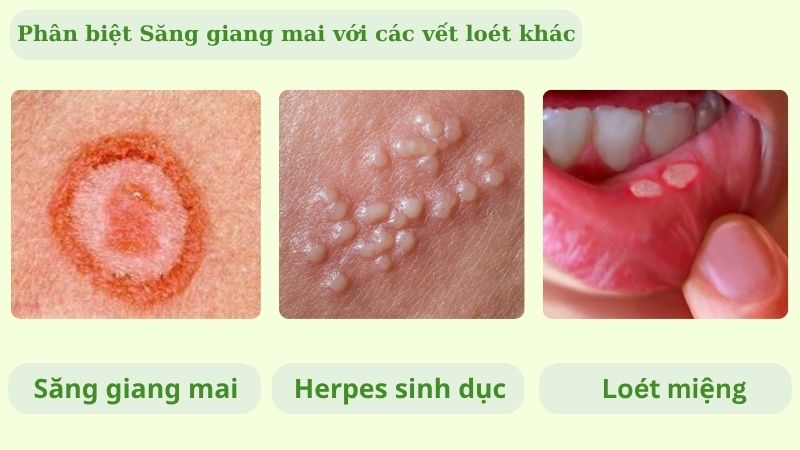 Hình ảnh phân biệt săng giang mai với các vết loét khác Hình ảnh phân biệt săng giang mai với các vết loét khác