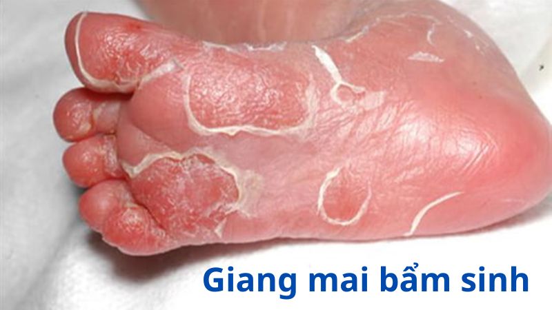 Hình ảnh giang mai bẩm sinh ở trẻ sơ sinh