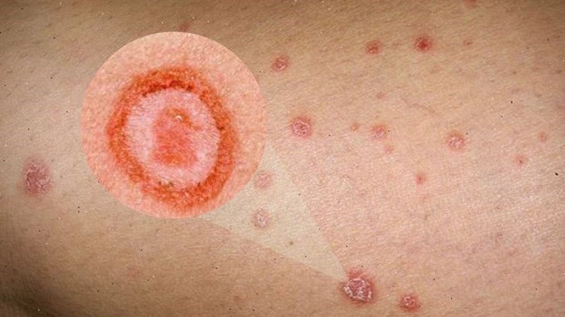 Hình ảnh bệnh giang mai (săng giang mai)