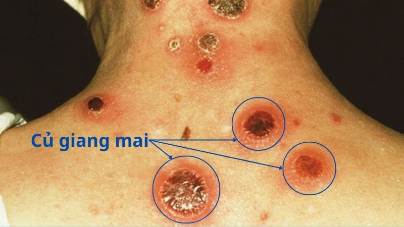 Xuất hiện củ giang mai ở giai đoạn cuối