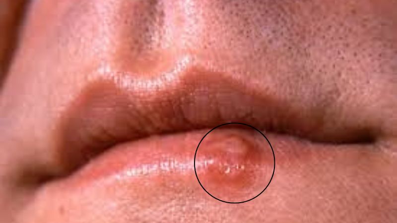 Xuất hiện tổn thương ở niêm mạc - vùng môi