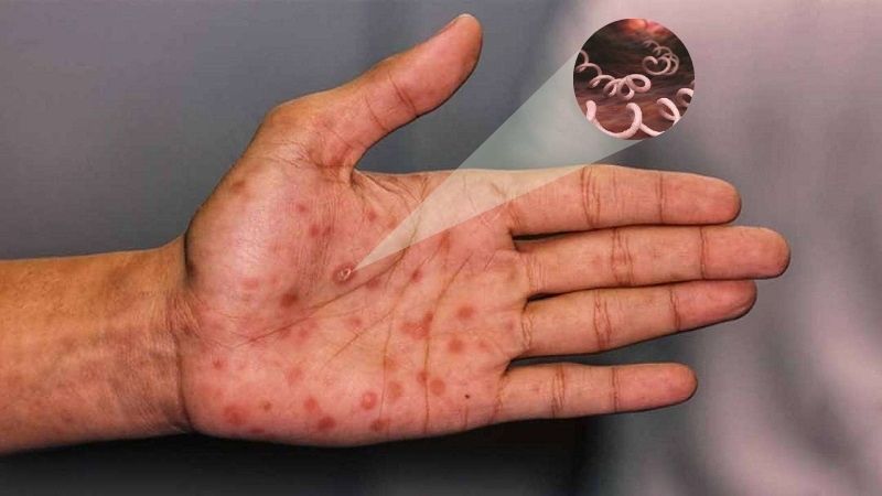 Bệnh giang mai có thể chữa khỏi nếu được phát hiện ở giai đoạn sớm