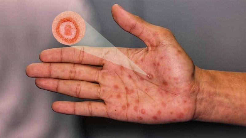 Hình ảnh bệnh giang mai