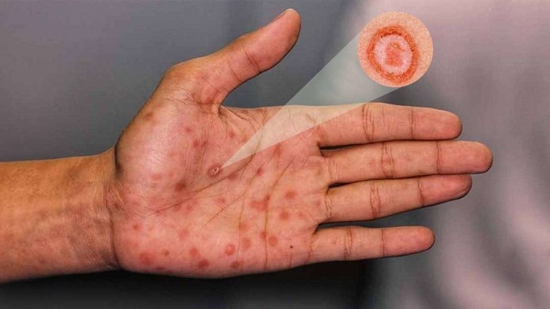 Giang mai không gây ngứa, dù xuất hiện các vết loét, phát ban trên da Giang mai không gây ngứa, dù xuất hiện các vết loét, phát ban trên da