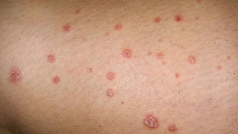 Hình ảnh bệnh giang mai Hình ảnh bệnh giang mai