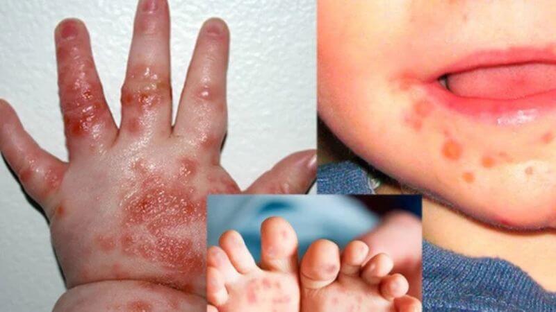 Bệnh tay chân miệng là một bệnh truyền nhiễm cấp tính phổ biến lây từ người sang người, đặc biệt ở trẻ nhỏ Bệnh tay chân miệng là một bệnh truyền nhiễm cấp tính phổ biến lây từ người sang người, đặc biệt ở trẻ nhỏ