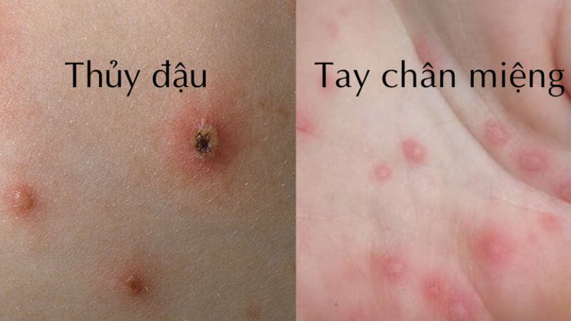 Phân biệt bệnh tay chân miệng với thủy đậu Phân biệt bệnh tay chân miệng với thủy đậu