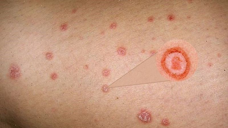 Nhận biết lây nhiễm dựa vào tiền sử tiếp xúc và các yếu tố nguy cơ Nhận biết lây nhiễm dựa vào tiền sử tiếp xúc và các yếu tố nguy cơ