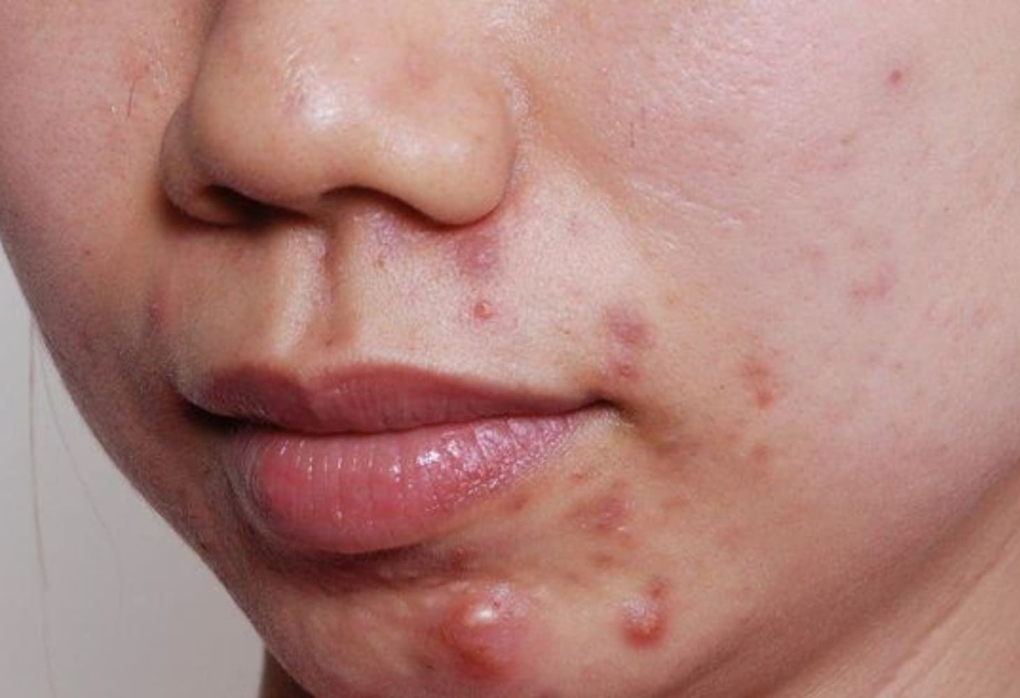 Mụn nội tiết thường mọc ở vùng cằm