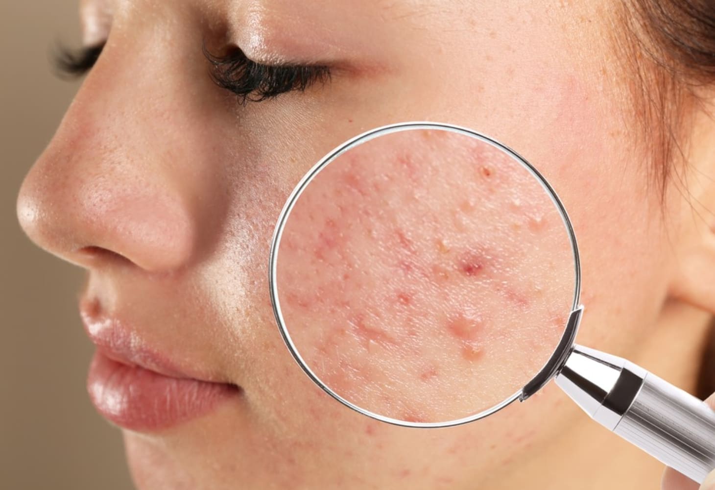 Mụn nội tiết là tình trạng mụn do biến đổi hormone trong cơ thể