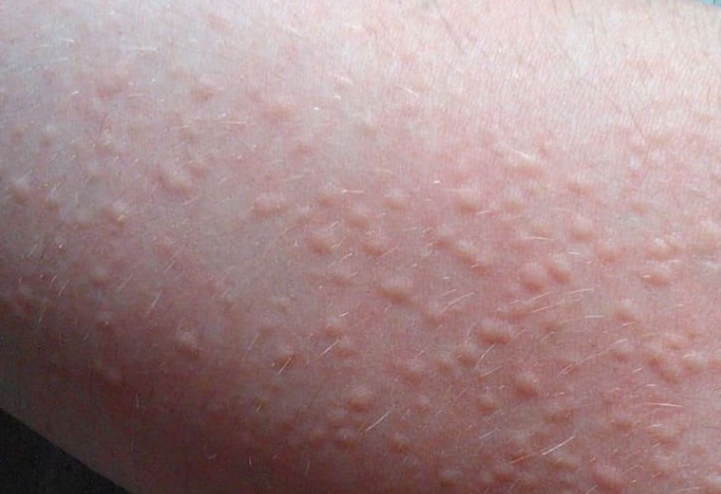 Tình trạng nổi mề đay sau khi tắm nước nóng