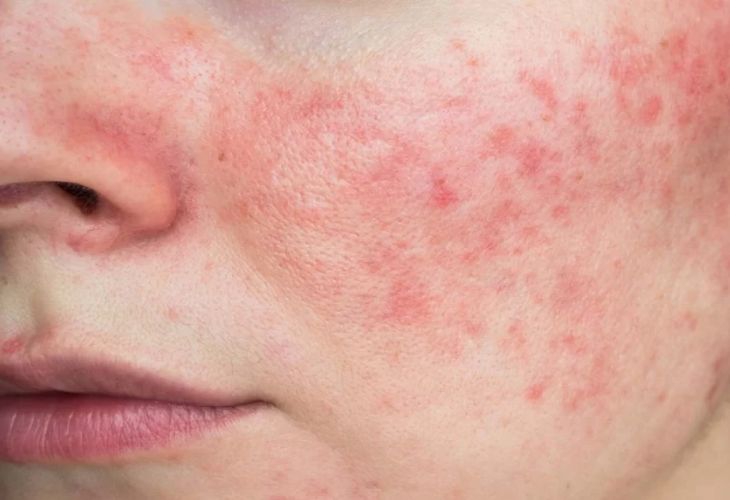 Kích ứng Retinol có thể khiến da bị đỏ, bỏng rát và khô