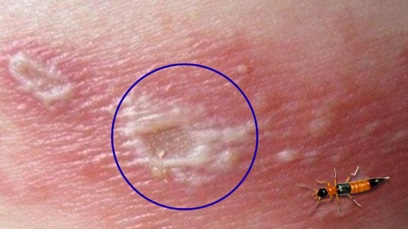 Các mụn nước tập trung thành cụm, vỡ ra nếu gãi hoặc chà xát