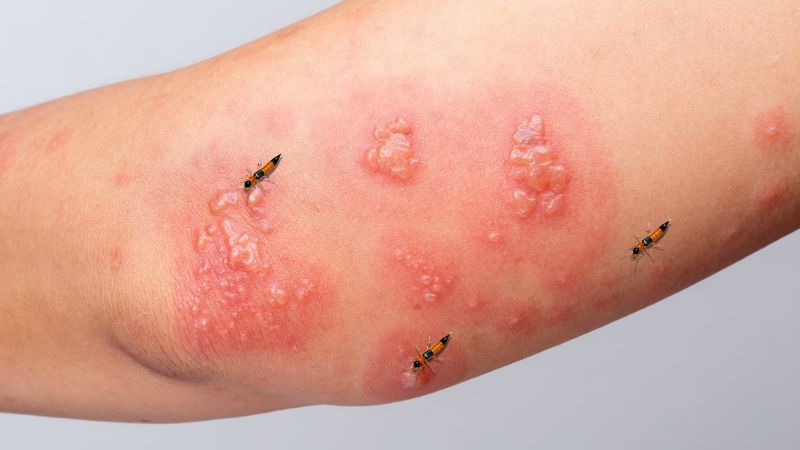 Vết đỏ dạng vệt dài, gây nóng rát và ngứa nhẹ, xuất hiện sau 12-24 giờ tiếp xúc