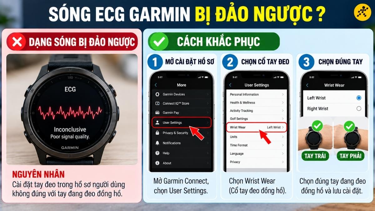 Dạng sóng điện tâm đồ bị đảo ngược Dạng sóng điện tâm đồ bị đảo ngược