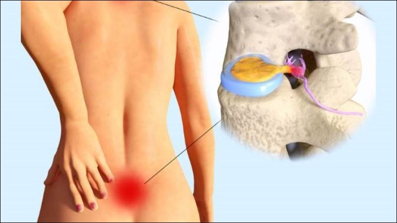 Thoát vị đĩa đệm mông thường gây đau nhói vùng thắt lưng cùng và mông