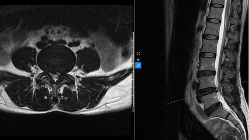 Chụp phim cộng hưởng từ MRI giúp chẩn đoán xác định thoát vị đĩa đệm