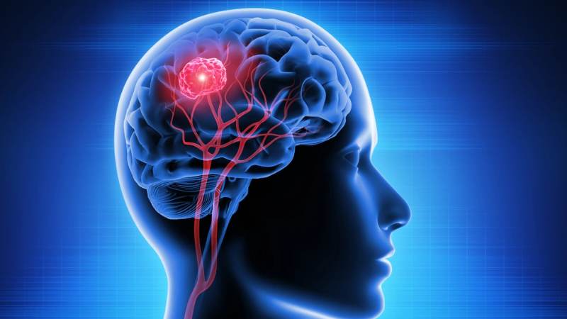 U não, dù lành tính hay ác tính vẫn rất nguy hiểm cho cơ thể U não, dù lành tính hay ác tính vẫn rất nguy hiểm cho cơ thể