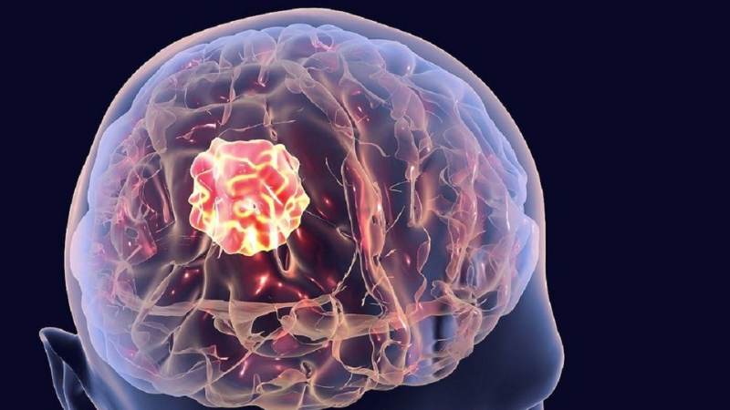 U não xảy ra do đột biến hoặc sự di căn U não xảy ra do đột biến hoặc sự di căn