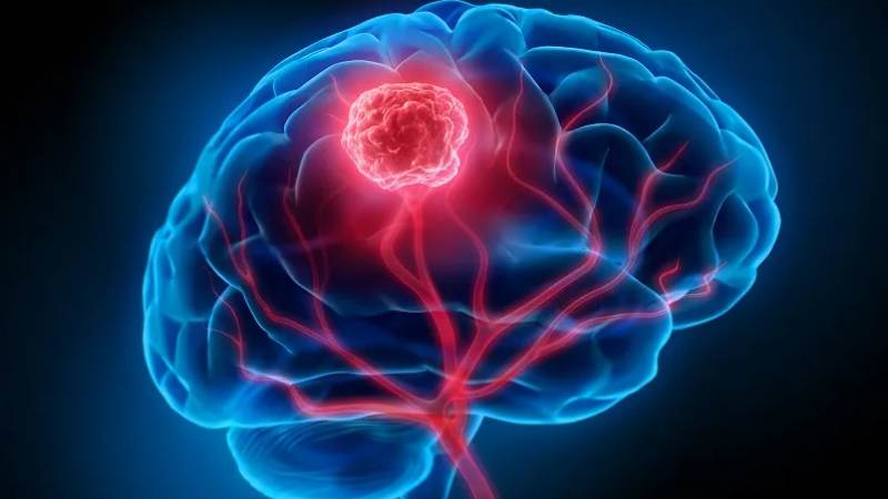 Khối u não có thể điều trị, kiểm soát được nếu phát hiện sớm Khối u não có thể điều trị, kiểm soát được nếu phát hiện sớm