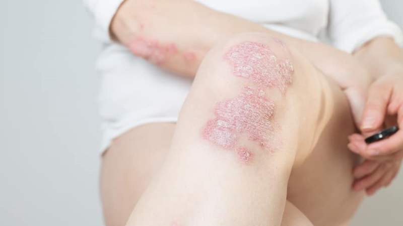 Bệnh vẩy nến là một tình trạng mạn tính, không thể chữa khỏi hoàn toàn