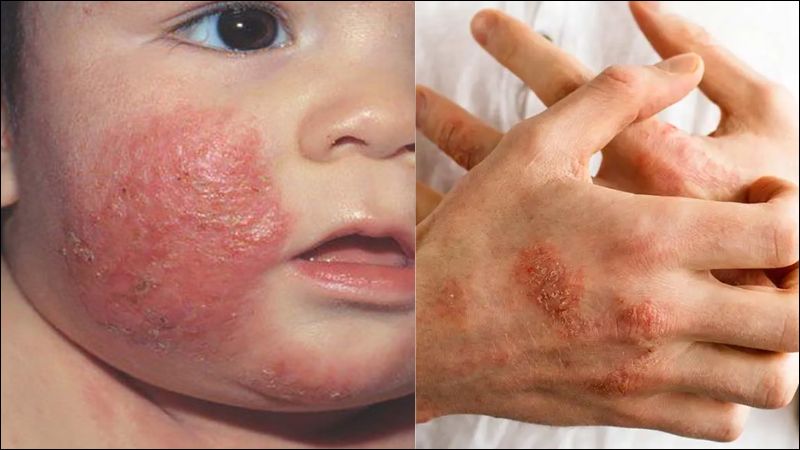  Một số hình hình ảnh viêm da cơ địa ở người lớn và trẻ em