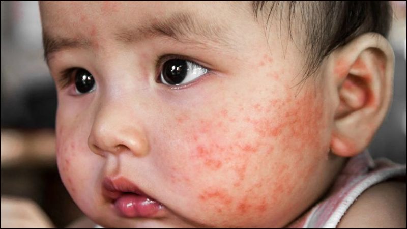 Số trẻ mắc viêm da cơ địa trong giai đoạn nhũ nhi có thể lên tới hơn 25%