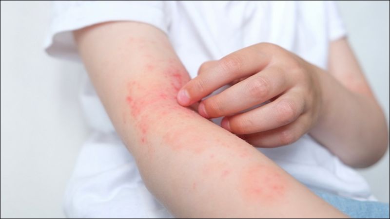 Gãi có thể làm tổn thương da trở nên nghiêm trọng hơn